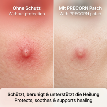 Preview: Pimple Patches – 72 Stück Akne Pflaster, Hydrocolloid Pickel Pflaster mit Teebaumöl & Salicylsäure, Unsichtbar & Wasserdicht, Effektive Behandlung für Pickel und Unreinheiten, Tag & Nacht Acne